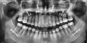 Teeth Imaging